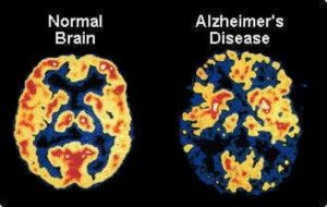 A Guide to Preventing Alzheimer's Disease