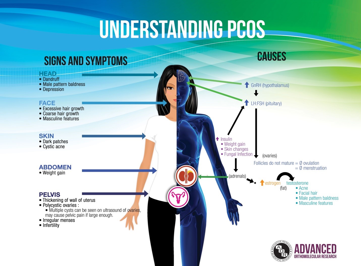 PCOS