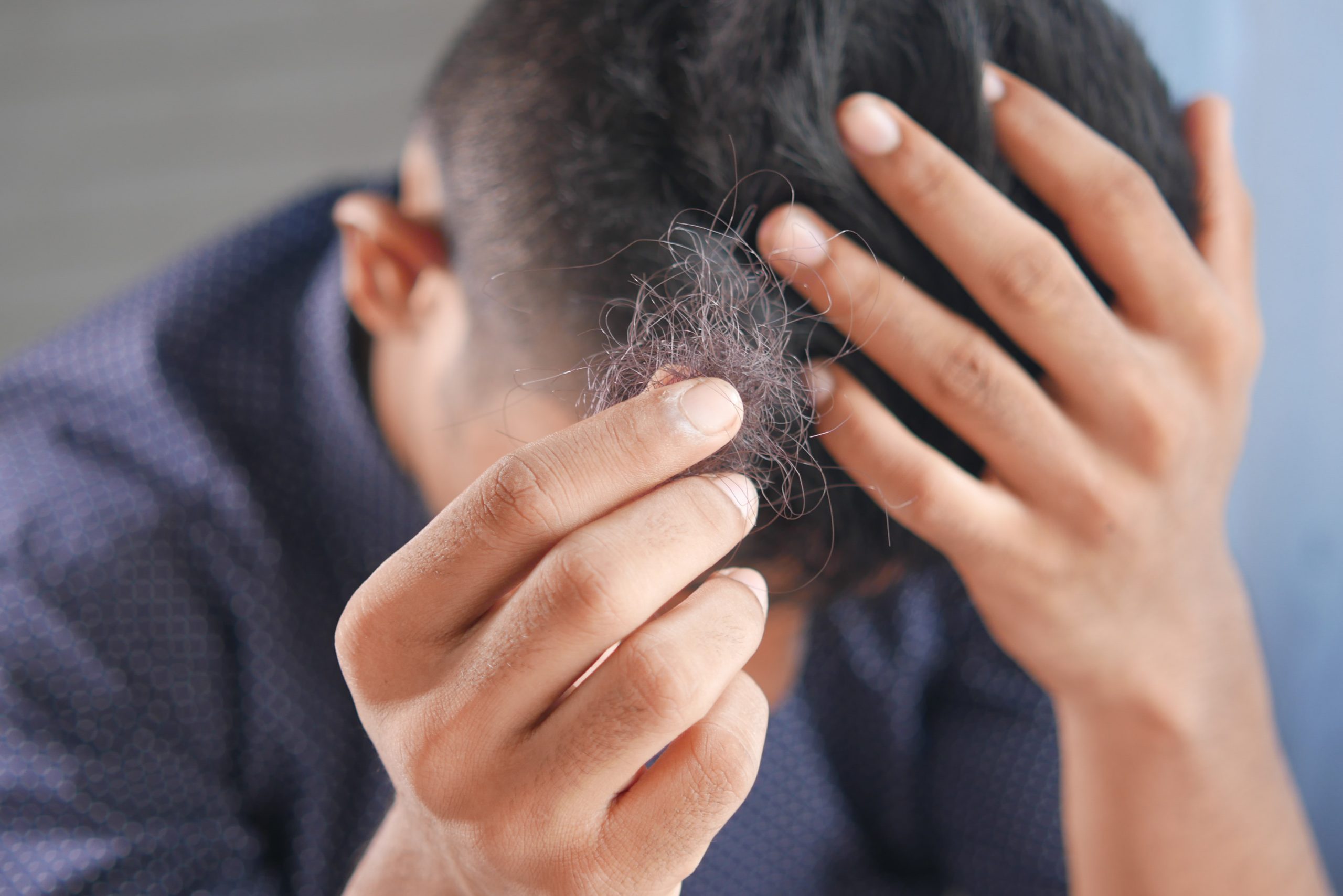 in article about hair loss, a person pulling hair out of his scalp